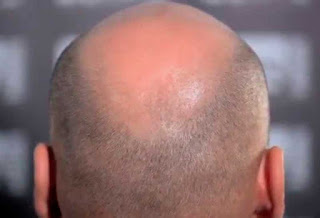 male pattern baldness, solutions