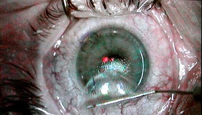 lasik_eye_surgery_secret