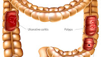 Remicade Side Effects Ulcerative Colitis