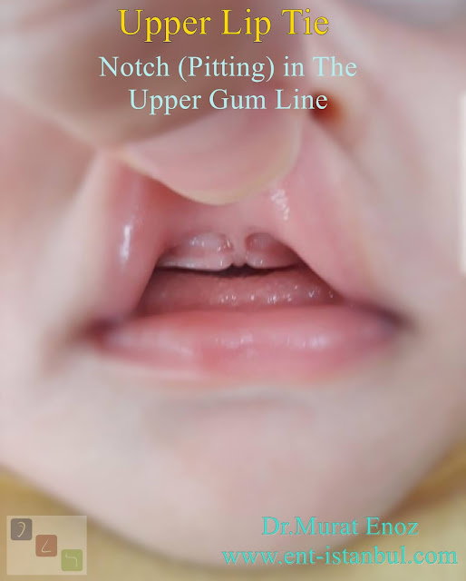 Notch (Pitting) in The  Upper Gum Line