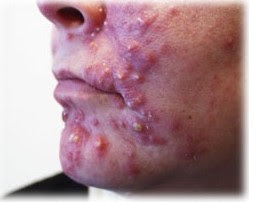 Causes, Characteristic and How to Cure Acne Sstone (Cystic Acne)