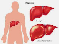 Cara Ampuh Mengobati Penyakit Hepatitis