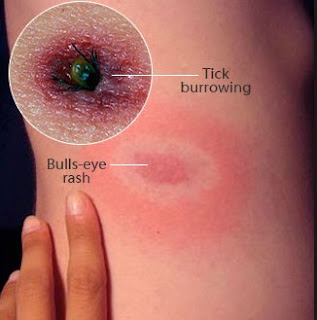 Lymes Disease Pictures