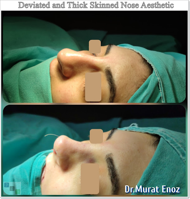 Deviated Nose and Treatment