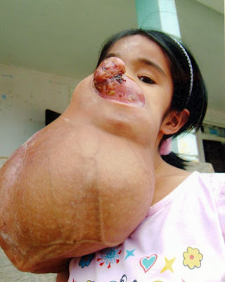 Thus these tumors can contain hair, bone and even teeth. Miraculous Facial 