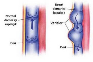 varis oluşması