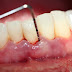 Cao răng dưới nướu là tình trạng bệnh lý nguy hiểm
