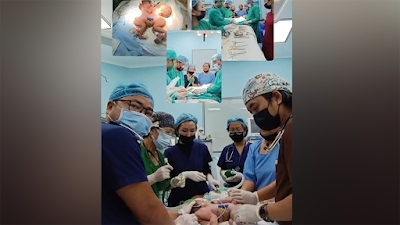 Conjoined twins successfully separated by a team of doctors in Mizoram. Babies are under observatio at Zoram Medical College (ZMC).
