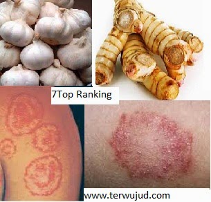 How to Overcome Disease Ringworm Naturally ~ My Article