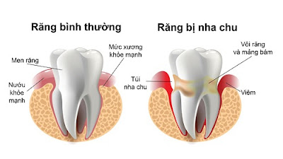 Viêm chân răng là gì? Dấu hiệu nhận biết 1