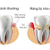 Viêm chân răng là gì? Dấu hiệu nhận biết