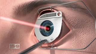 Sides Effects of Ocular Laser Surgery