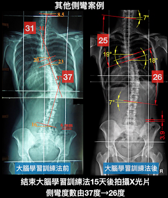 脊椎側彎矯正成功, 脊椎側彎, 脊椎側彎治療, 脊椎側彎運動,脊椎側彎台中