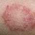 Cara Menyembuhkan Gatal Psoriasis Secara Alami 