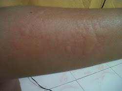 Apes Tangan Dan Kaki Bentol2