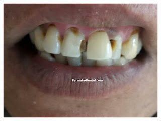 foto, gambar, gigi depan hitam Permata Dental Bali| sebelum dan sesudah gigi hitam diperbaiki di Permata Dental Bali | foto gigi keropos hitam Permata Dental Bali |gigi hitam karena sakit | gigi hitam berlubang di Permata Dental Bali | gigi hitam depan di Permata Dental Bali | gigi hitam bagian belakang | foto gigi hitam yang sudah diperbaiki Permata Dental Bali |  gigi hitam bagian depan| foto gigi keropos dan hitam, foto gigi hitam oleh Permata Dental Bali , Bali Hits, Bali banget, area Bali, Bali  kota, area kampus Bali. veneer gigi hitam Bali | gambar sebelum dan sesudah veneer gigi hitam dan berlubang  veneer gigi hitam Bali | veneer gigi hitam denpasar| veneer gigi hitam nusadua | veneer gigi hitam ngurahrai| veneer gigi hitam badung| veneer gigi hitam jember jimbaran| veneer gigi hitam gatsu| veneer gigi hitam bali | veneer gigi hitam bagus di Permata Dental Bali | veneer gigi hitam baik di Permata Dental Bali | veneer gigi hitam cepat di Permata Dental Bali | veneer gigi hitam murah di Permata Dental Bali | veneer gigi hitam aman di Permata Dental Bali | veneer gigi hitam mudah di Permata Dental Bali | veneer gigi hitam promo Permata Dental Bali | gambar veneer gigi hitam Permata Dental Bali | gambar sebelum dan sesudah veneer gigi hitam dan berlubang Permata Dental Bali | veneer gigi hitam bagus | veneer gigi hitam baik | veneer gigi hitam cepat | veneer gigi hitam murah| veneer gigi hitam aman | veneer gigi hitam mudah  | veneer gigi hitam promo | gambar veneer gigi hitam | gambar sebelum dan sesudah veneer gigi hitam dan berlubang Permata Dental Bali | foto veneer gigi hitam Permata Dental Bali |perbaiki gigi hitam Permata Dental Bali | cara mengatasi gigi hitam Permata Dental Bali | menghilangkan gigi hitam Permata Dental Bali | cara menghilangkan gigi hitam Permata Dental Bali | cara memutihkan  gigi hitam Permata Dental Bali | membantu menghilangkan gigi hitam Permata Dental Bali | perbaiki Permata Dental Bali | harga perbaiki gigi hitam Permata Dental Bali | perbaiki gigi hitam murah  Permata Dental Bali | perbaiki gigi hitam promo Permata Dental Bali | perbaiki gigi hitam bagus Permata Dental Bali | perbaiki gigi hitam  aman Permata Dental Bali | perbaiki gigi hitam cepat  Permata Dental Bali | perbaiki gigi hitam mudah Permata Dental Bali | harga perbaiki gigi hitam mudah Permata Dental Bali | perbaiki gigi hitam Permata Dental Bali |proses perbaiki gigi hitam mudah Permata Dental Bali | foto perbaiki gigi hitam Permata Dental Bali | gambar perbaiki gigi hitam Permata Dental Bali | perbaiki gigi hitam mudah Permata Dental Bali | perbaiki  gigi hitam bali| perbaiki  gigi hitam denpasar  | perbaiki  gigi hitam nusadua| perbaiki  gigi hitam badung| perbaiki  gigi hitam ngurahrai| perbaiki  gigi hitam gatsu| perbaiki  gigi hitam jimbaran| perbaiki  gigi hitam tabanan| perbaiki  gigi hitam