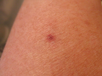 white tail spider bite symptoms. white tail spider bite