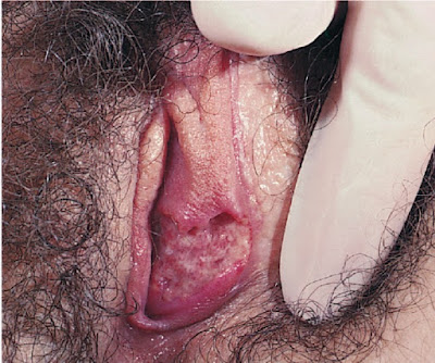 Genital ulcer due to Behçet syndrome in a 23-year-old woman born in Turkey