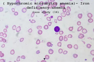 Case study (34) –( Hypochromic microcytic anemia)- Iron deficiency anemia