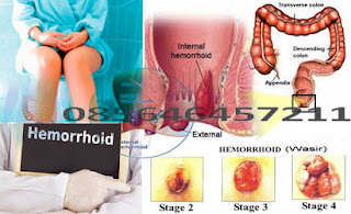 Wasir Bengkak Bisa Sembuh Tanpa Operasi
