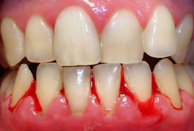 Đánh răng bị chảy máu là bệnh gì?