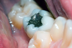<Img src ="amalgama-dental.jpg" width = "600" height "400" border = "0" alt = "Amalgam dental".>
