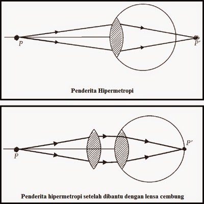 Penyebab dan Menanggulangi Cacat Mata Hipermetropi Rabun 