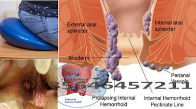 Salah Satu Obat Hemoroid (wasir) Alami