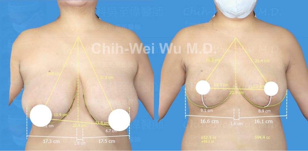 在嚴重下垂的胸部，縮胸提乳手術可以將乳頭上提10公分以上