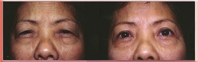 Asian upper blepharoplasty