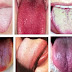 See what your Tongue can tell you about your Health even without seeing a doctor.