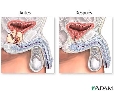 Resultado de imagen para 3 problemas prostata