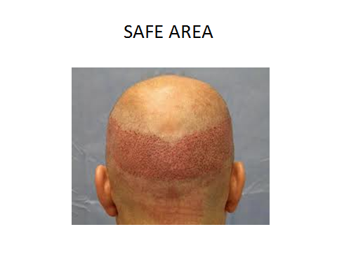 Hair transplant in Jaipur