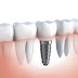 Trồng răng implant hết bao nhiêu tiền ?