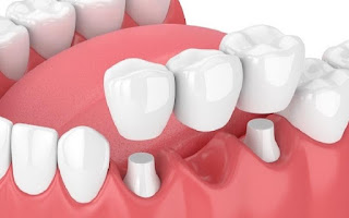 Cầu răng sứ bị lung lay phải làm sao-2