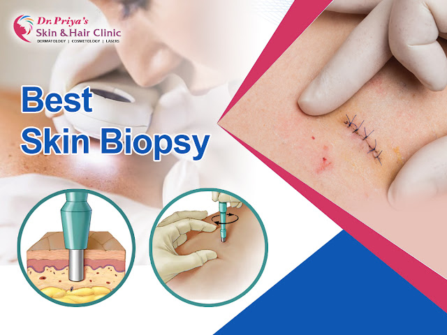 Best Skin Biopsy in Bangalore