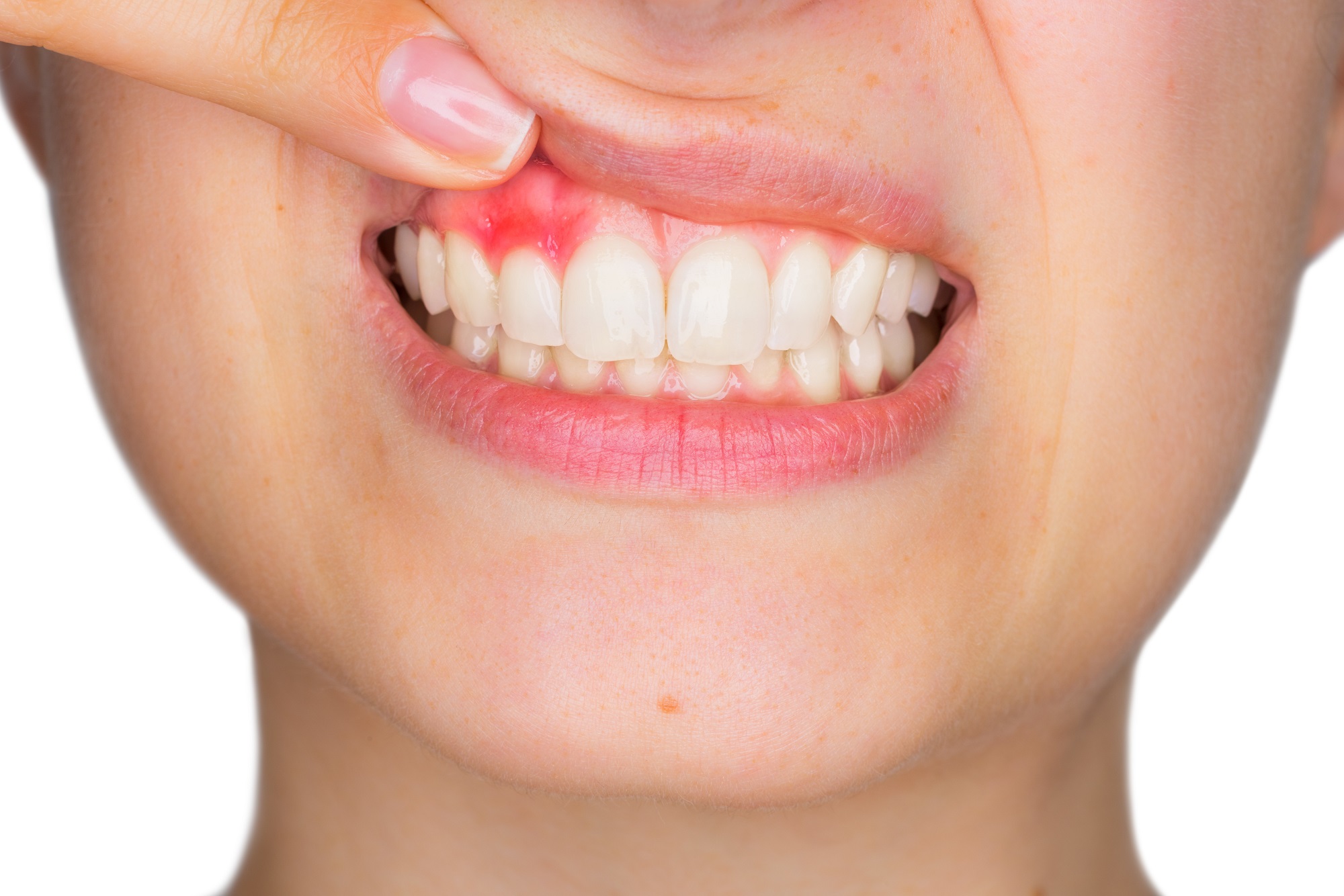 Tooth Gum Disease