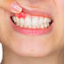 Tooth Gum Disease (Gingivitis and Periodontitis)