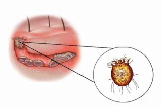 Maladie de gale ou mal de Sainte-Marie est une affection contagieuse de la peau, déterminée par la femelle d'un acarien microscopique (Sarcoptes scabiei), spécifique de l'homme, qui creuse dans l'épiderme des galeries (sillons) où elle dépose ses oeufs, provoquant de vives démangeaisons nocturnes. Cet acarien avait été décrit dès 1687 par Bonomo et Cestoni qui en avaient fait d'emblée le responsable des lésions de la peau. Mais cette importante découverte passa inaperçue et l'on persista jusqu'au XIXe siècle à faire de la gale une maladie humorale. Le rôle du sarcopte sera définitivement confirmé par Renucci (1834).