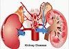 How to prevent and control kidney problems/diseases