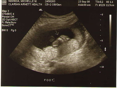 +of+a+girl+at+13+weeks ultrasounds at 13 weeks. +of+a+girl+at+13+weeks