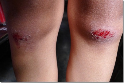 bleeding knees