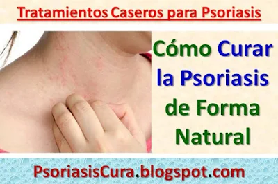 como-curar-la-psoriasis-con-remedios-caseros