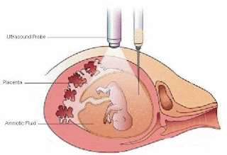 AMNIOCENTESIS AND TEST TUBE BABY