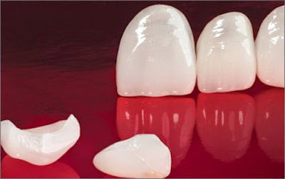 Tại sao nên bọc răng sứ Cercon thẩm mỹ ?
