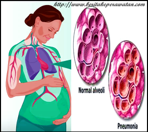 Penyakit Paru Paru Pada Ibu Hamil