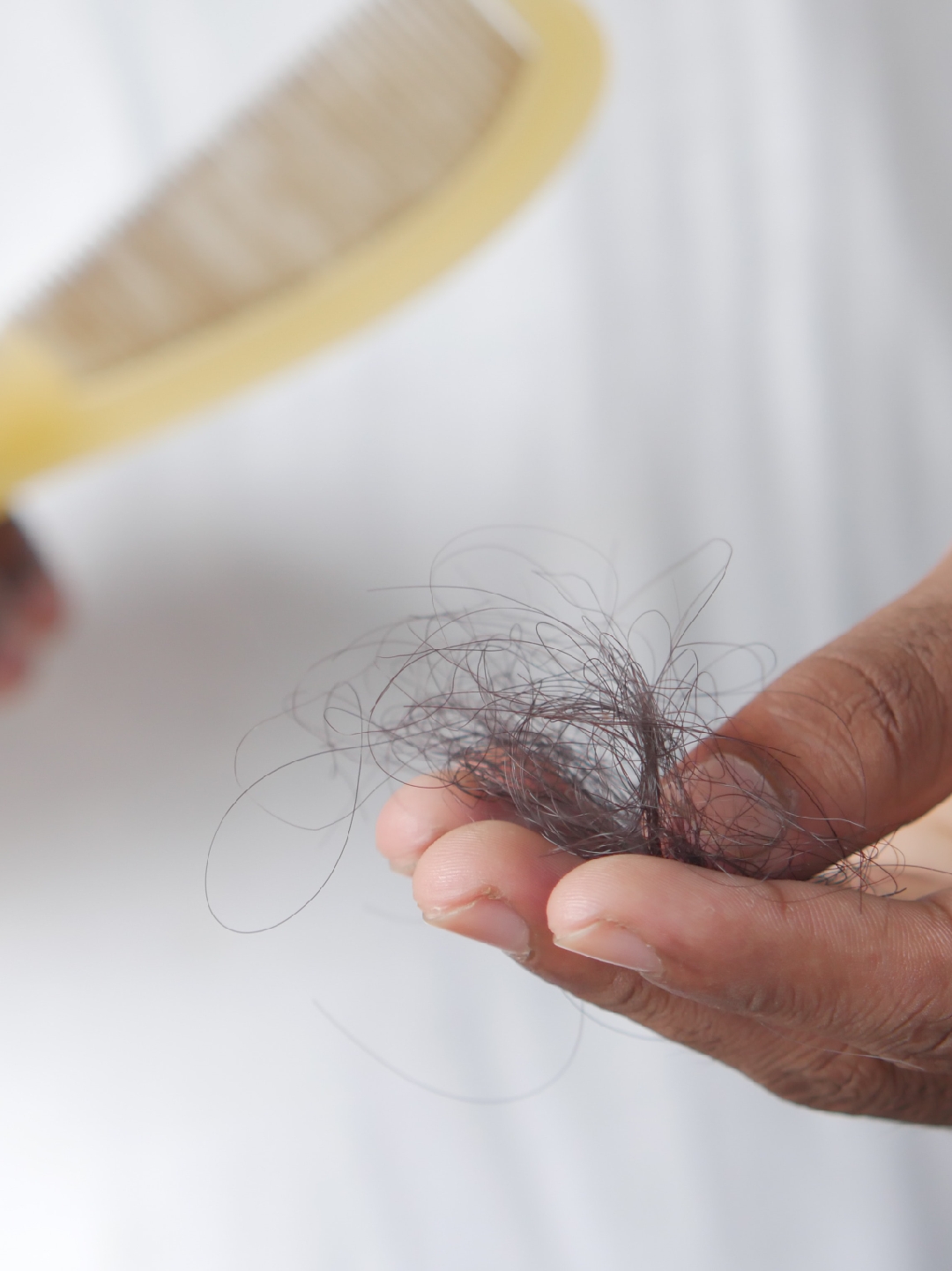 What is alopecia areata and how is it managed?