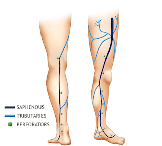 Varicose and Spider Veins