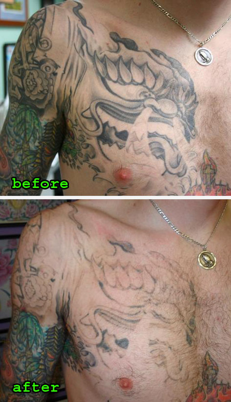free tattoo removal. tattoo removal methods