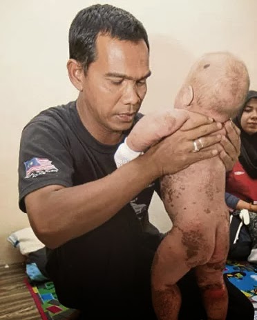 INI CERITA DARI MAK NGAH: Badan bayi 8 bulan melecur 